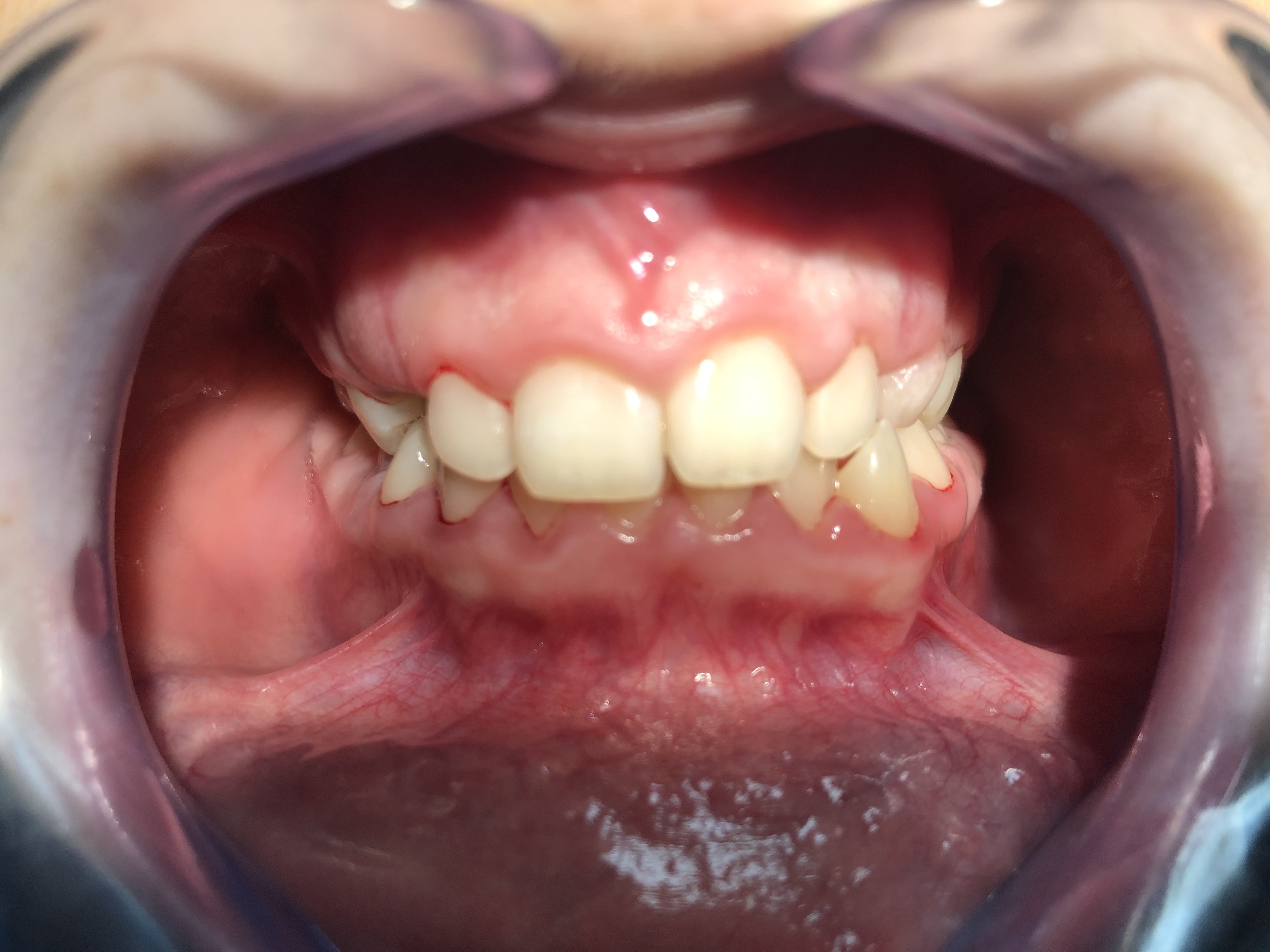 Dientes apiñados antes del tratamiento de ortodoncia en la clínica dental de Sants