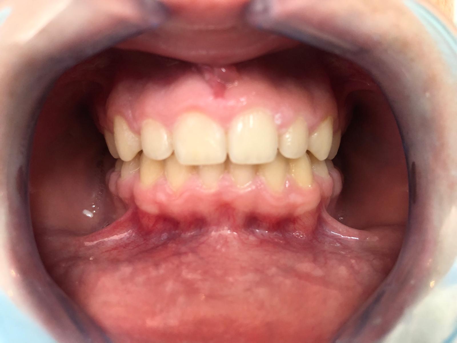 Dientes alineados después del tratamiento de ortodoncia en la clínica dental de Sants